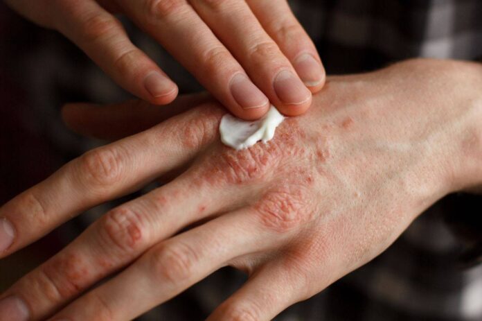 psoriasis
