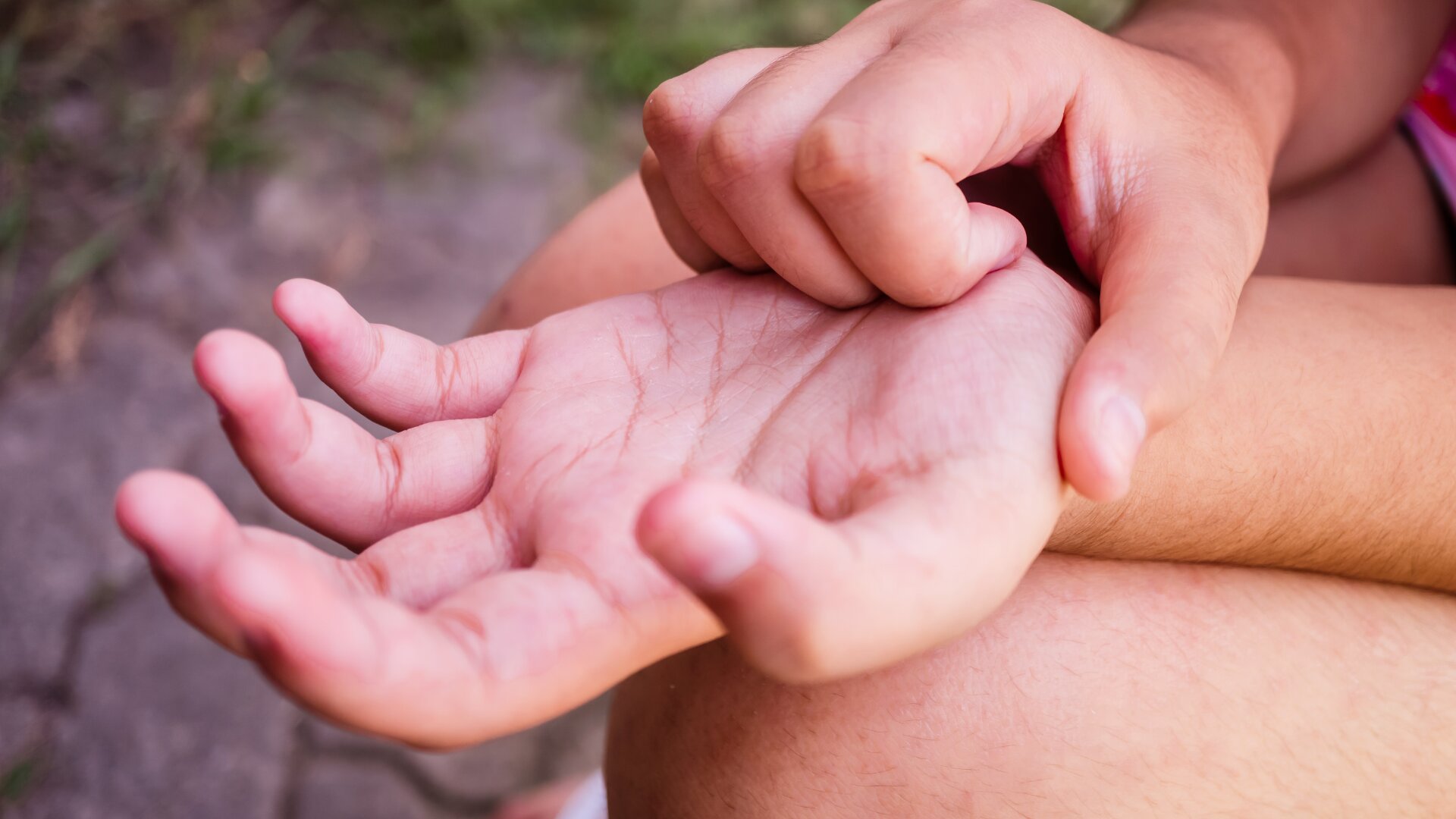 Dermatitis Atópica